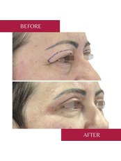 Eyelid surgery - upper lid - CORAMED Beauty Surgery