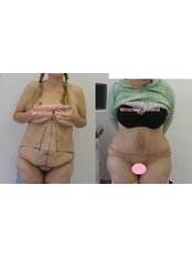 Tummy Tuck fleur de lis - CORAMED Beauty Surgery