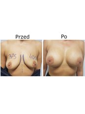 Breast Augmentation - NawMedica