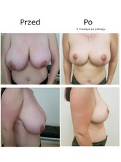 Breast Reduction - NawMedica