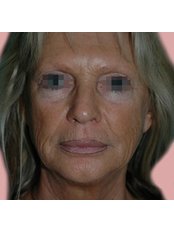 Facelift - Professional Beauty