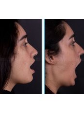 TMJ Arthroscopy - Instituto Português da Face