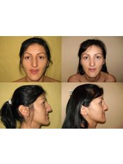 Rhinoplasty - Bendis Medical Dr. Voicu - Chirurgie Estetica