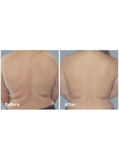 Before-After BodyTite Liposuction - Clinic Aesthetic SLIMART