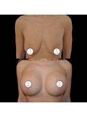 Breast Implants - Clinica Dr. Carmen Giuglea