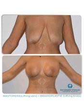 Breast Lift - Clinica Dr. Carmen Giuglea