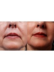 Treatment for Wrinkles - Clinica de Chirurgie Estetica 
