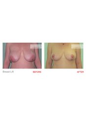 Breast Lift - New Look Holiday