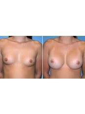 Breast Implants - Victoria Regia