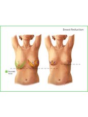 Breast Reduction - Victoria Regia