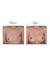 Breast Reconstruction - Victoria Regia