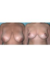 Breast Reduction - Beauty Trust Line Cosmetic Surgery Slovakia