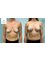 Dr. Suleman Vadia - Breast Augmentation | Before & After 