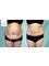 Dr. Suleman Vadia - Liposuction & Tummy Tuck | Before & After 