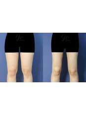 Thigh Liposuction - Modelline Clinic