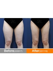 Liposuction - Modelline Clinic