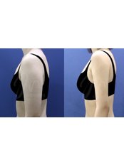 Arm Liposuction - Modelline Clinic