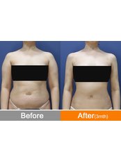 Liposuction Consultation - Modelline Clinic