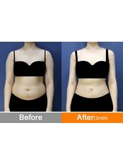 Liposuction - Modelline Clinic
