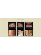 Liposuction - Evita Clinic