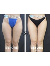 Thigh Liposuction - Evita Clinic