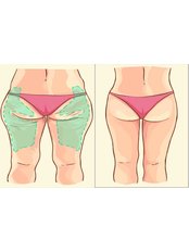 Thigh Liposuction - Evita Clinic