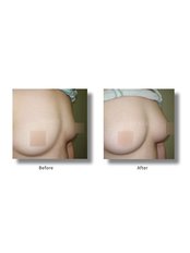 Fat Transfer - Breast Augmentation - Jeunex Clinic