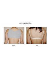 Arm Liposuction - Jeunex Clinic