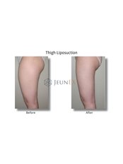 Thigh Liposuction - Jeunex Clinic