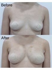 Fat Transfer - Breast Augmentation - Jeunex Clinic