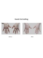 Hands rejuvenation - Fat Grafting - Jeunex Clinic