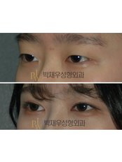 Eyelid surgery - Park Jae Woo