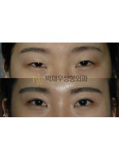 Eyelid surgery - Park Jae Woo