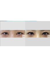 Double Eyelid Surgery - Pitangui Medical & Beauty