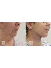 Neck Liposuction - Pitangui Medical & Beauty
