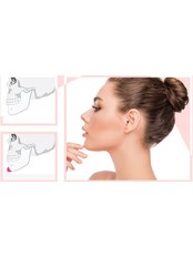 Chin Implant - Pitangui Medical & Beauty
