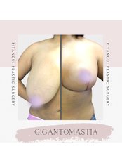 Breast Lift - Pitangui Medical & Beauty
