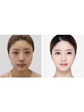 Facelift - Pitangui Medical & Beauty