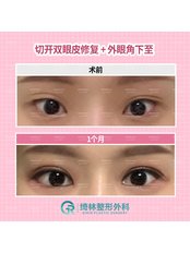 Eyelid surgery - Girin Plastic Surgery