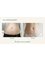 Girin Plastic Surgery - Body contouring Injection 