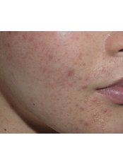Acne Treatment - Herne Clinic