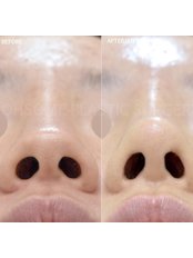 Nasal Tip Surgery - OhSome Plastic Surgery