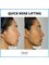Onlif Plastic Surgery - Quick Nose Lifting 
