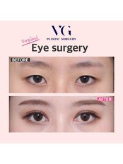 Double eyelid surgery - VERY GOOD Plastic surgery