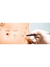 Liposuction - Medcare Spain