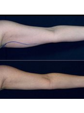 Arm Liposuction - Clinica Sanza