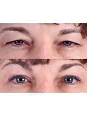 Eyelid surgery - Clinica Sanza