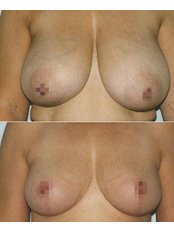Breast Reduction - Clinica Sanza