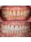 Dr Birbe - Dental Rejuvenation - Veneers 