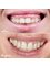 Dr Birbe - gummy smile treatment 